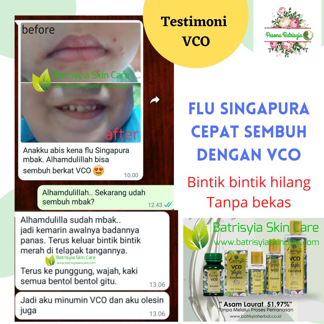 flu singapura sembuh dengan VCO