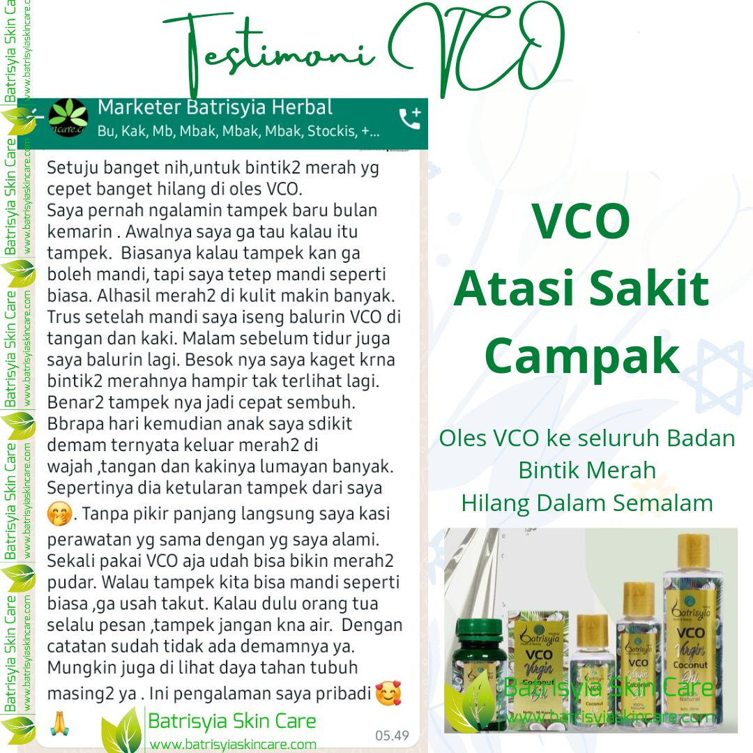 VCO atasi sakit Campak
